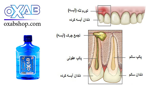 بهبود التهابات عفونی لثه و آبسه های دندان با آب غنی شده با اکسیژن