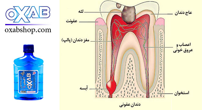  بهبود التهابات عفونی لثه و آبسه های دندان با (آب غنی شده و دینامیزه شده با اکسیژن )